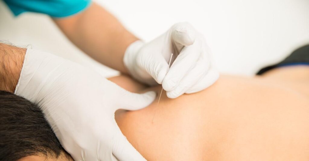 Dry needling behandeling met dunne naalden voor stimulatie van triggerpoints in spieren